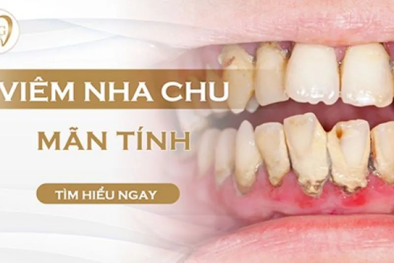 Viêm nha chu mãn tính là gì?