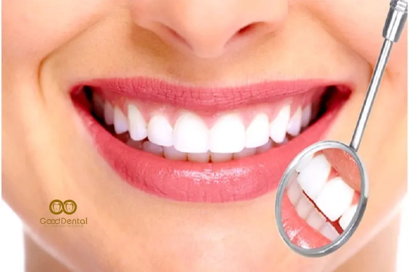 Cẩm Nang Phục Hình Răng Sứ Toàn Diện Từ A Đến Z