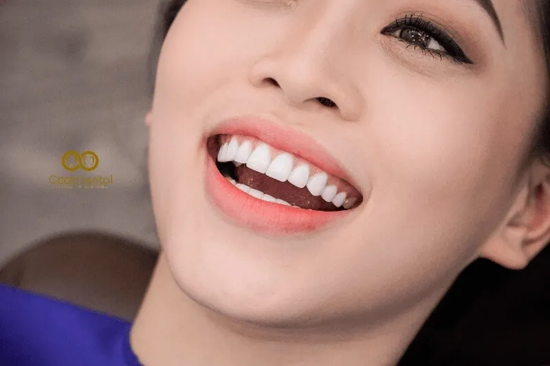 Những Lưu Ý Trước Và Sau Dán Veneer Bạn Nên Biết