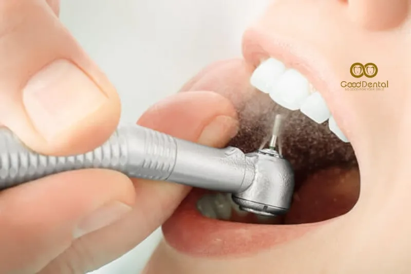 Hình Ảnh Mài Răng Dán Sứ, Mài Răng Có Đau Không?