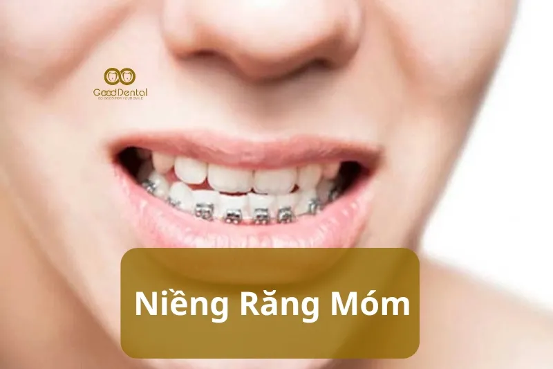 Niềng Răng Móm - Giải Pháp Chỉnh Nha Toàn Diện Cho Khớp Cắn Ngược