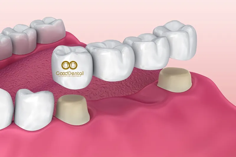 5+ Hình Ảnh Cầu Răng Sứ, Lợi Ích Của Cầu Răng Sứ