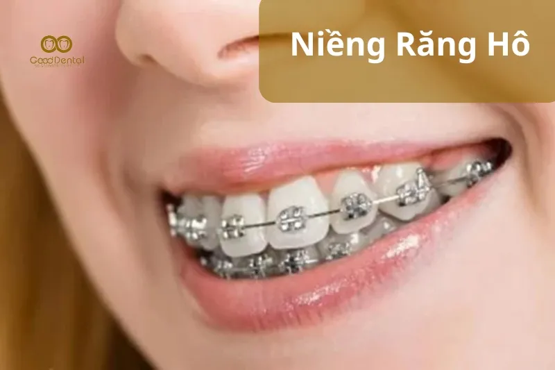 Niềng Răng Hô