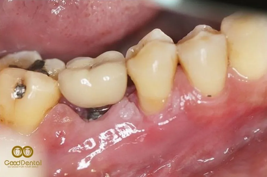 Răng Implant Có Thể Bị Sâu Không?