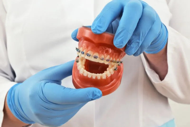Việt Kiều Nên Niềng Răng Ở Việt Nam Hay Nước Ngoài?