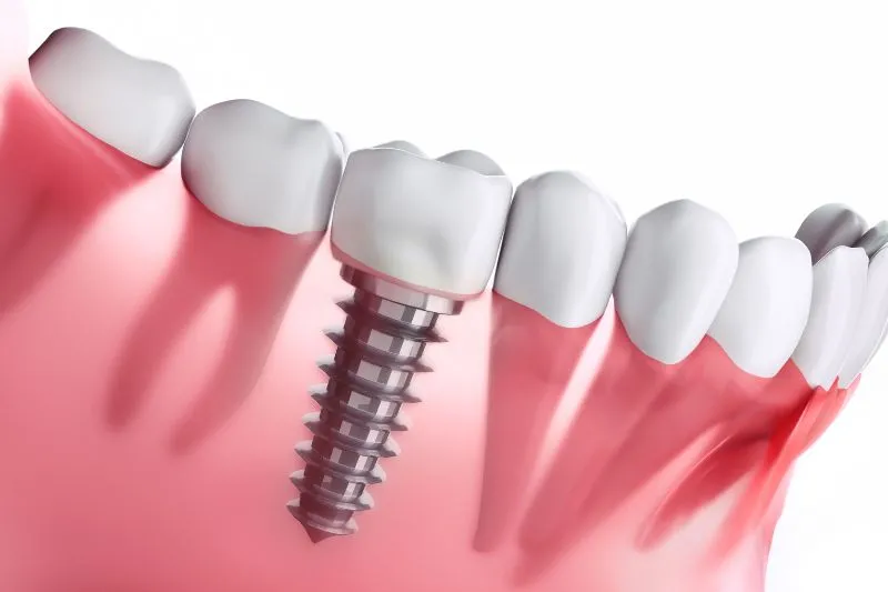 Trồng Implant ở Việt Nam: Chi phí và chất lượng điều trị như thế nào so với nước ngoài?