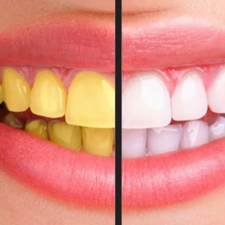 Răng Sứ Có Bị Ố Vàng Không? Nên Chăm Sóc Răng Như Thế Nào?