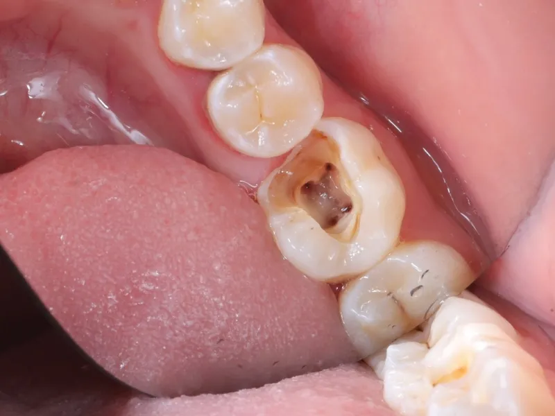 Điều trị sâu răng: Nên bọc răng sứ hay trám răng sẽ tốt hơn?