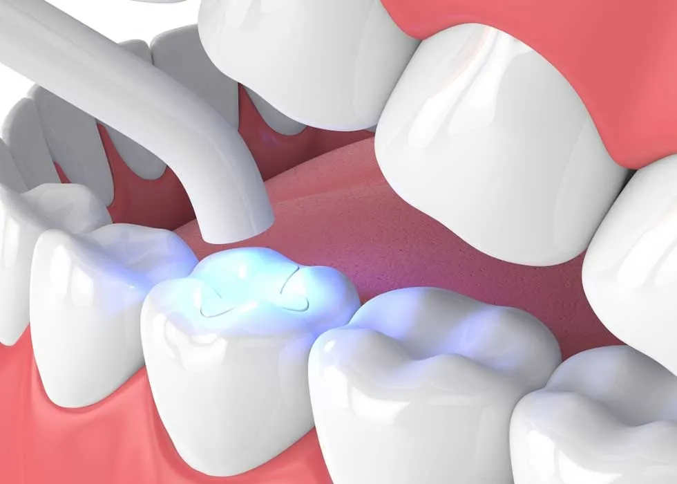 Điều trị sâu răng: Nên bọc răng sứ hay trám răng sẽ tốt hơn?