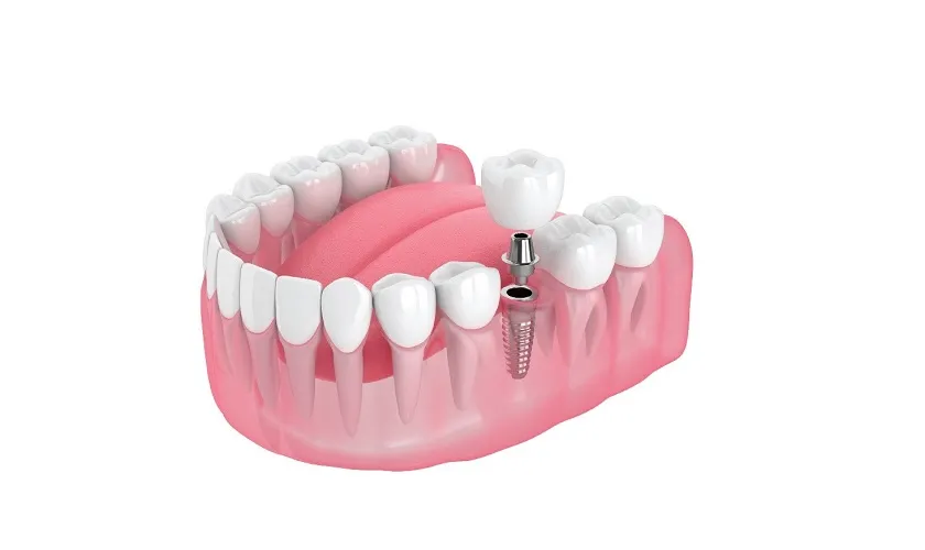 Phân biệt các loại phục hình răng sứ: Mão sứ, Veneer, Cầu răng, Implant – Giải pháp nào phù hợp với bạn?