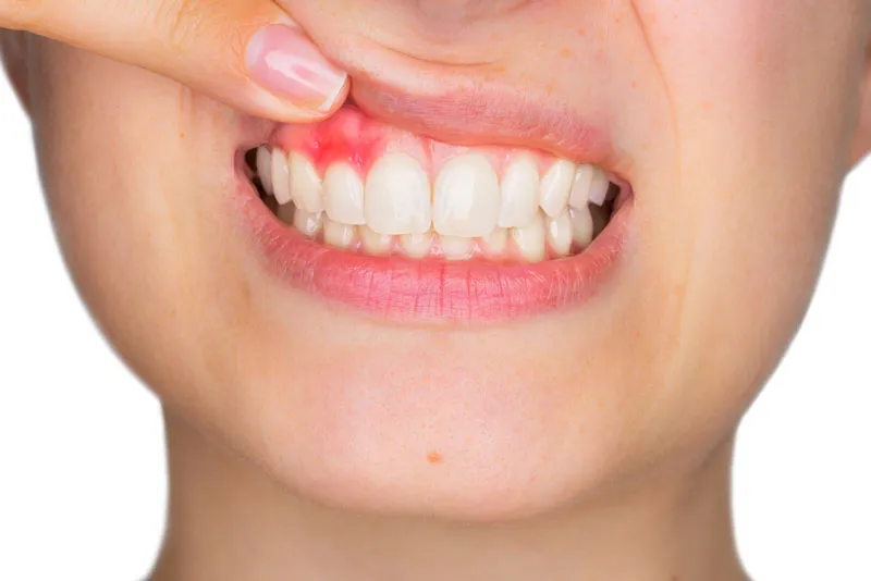 Những Sai Lầm Phổ Biến Trong Việc Chữa Trị Bệnh Nha Chu Tại Nhà