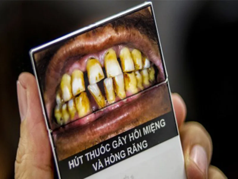 Hút Thuốc Tăng Nguy Cơ Mắc Bệnh Nha Chu Gấp 6 Lần